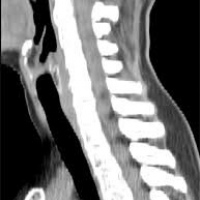 Tomografia axial computada con contraste de cuello (tejidos blandos).879161  Idime