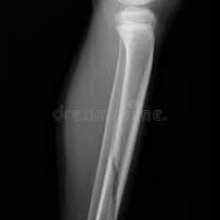 Radiografia pierna AP y lateral. 873313. Idime