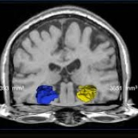 Resonancia nuclear magnetica con contraste de cerebro con volumetria de hipocampos. 883112 Idime