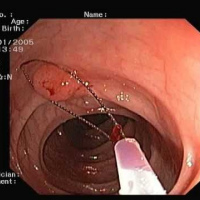 Polipectomia en procedimiento gastrica y colonica.Uniendoscopia (2023)