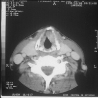 Tomografia axial computada de laringe.879162  Idime
